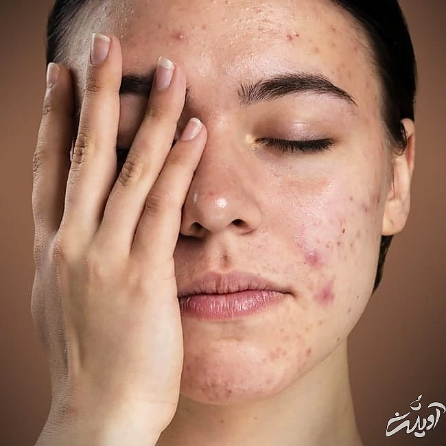 جوش صورت و راهکارهای از بین بردن آن